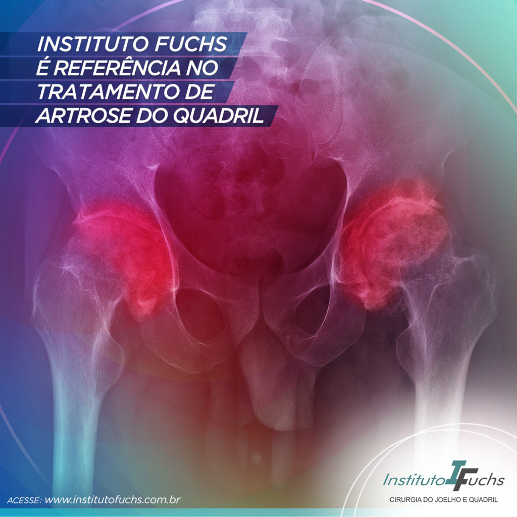 Instituto Fuchs é referência no tratamento de artrose do quadril em Curitiba