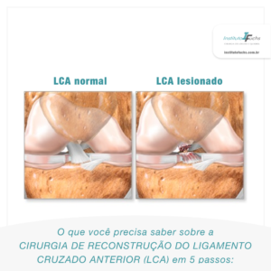 O que você precisa saber sobre o pré e pós-operatório de uma cirurgia no  joelho.