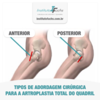 Tipos de abordagem cirúrgica para a artroplastia total do quadril