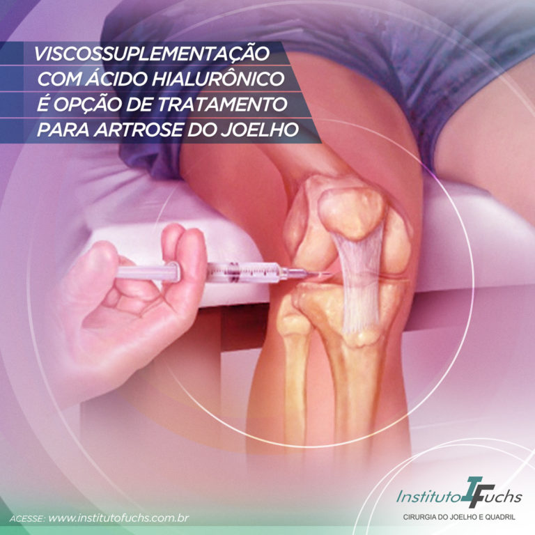 Viscossuplementação com ácido hialurônico é opção de tratamento para artrose do joelho