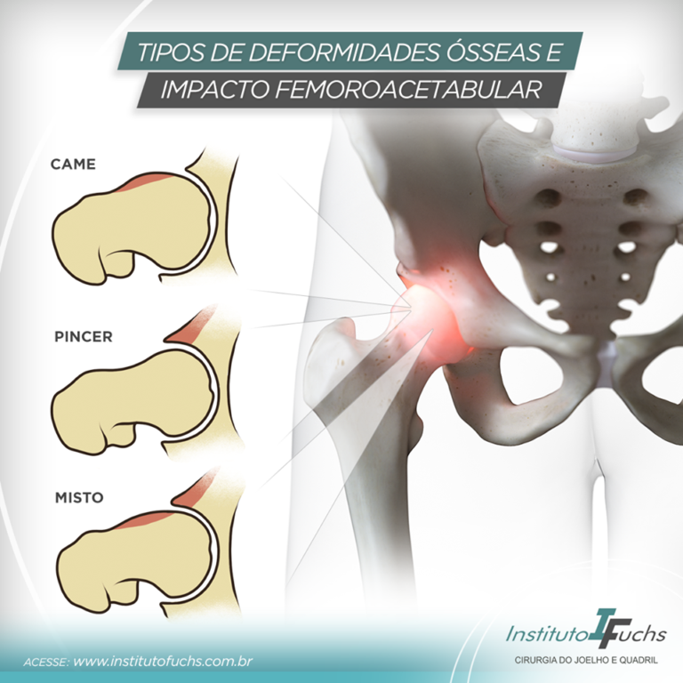 Tipos de deformidades ósseas e impacto femoroacetabular