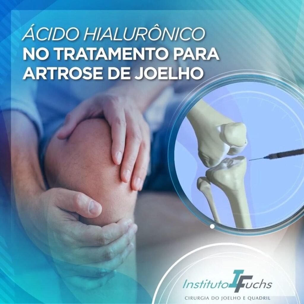 Ácido hialurônico no tratamento para artrose de joelho – Tratamento de ...