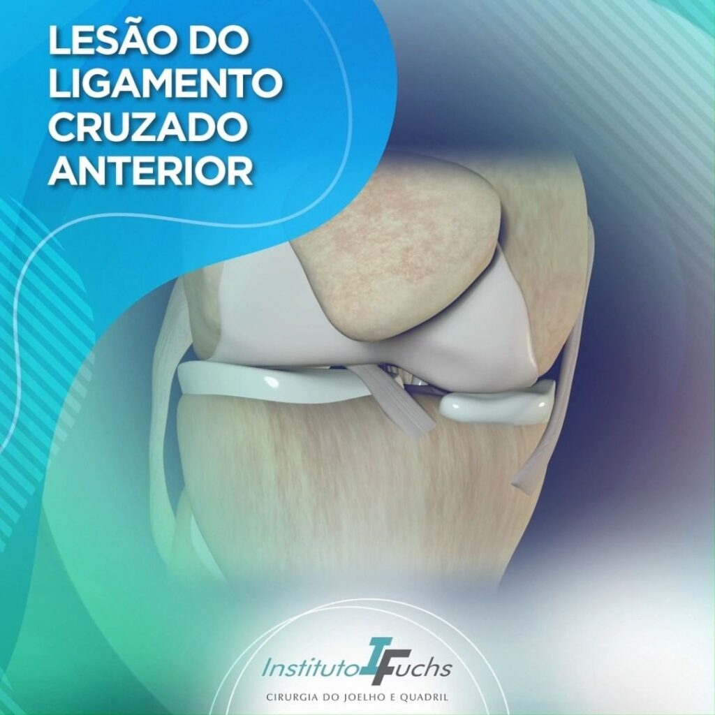Lesão do ligamento cruzado anterior Tratamento de Joelho e Quadril em Curitiba