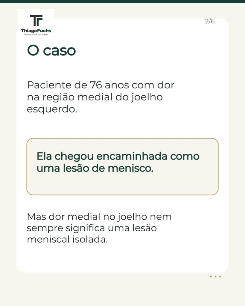 O caso: paciente de 76 anos com dor na região medial do joelho esquerdo. Ela chegou encaminhada como uma lesão de menisco, mas dor medial no joelho nem sempre significa uma lesão meniscal isolada.