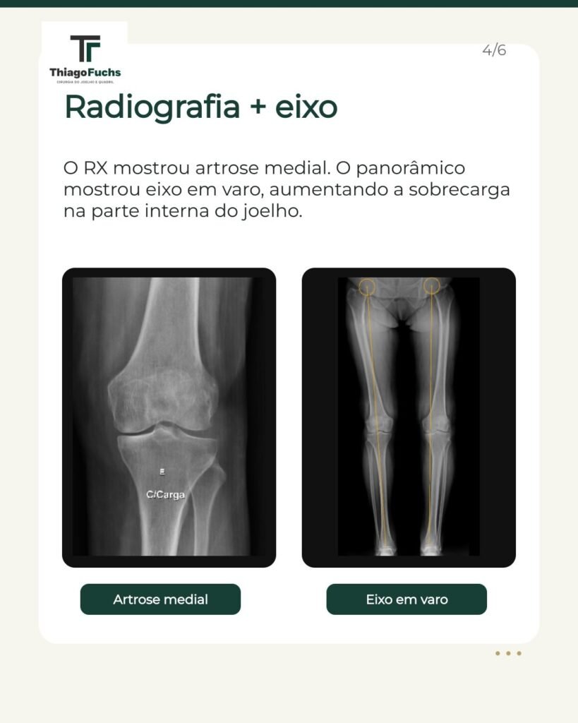 Radiografia e eixo: o raio X mostrou artrose medial e o panorâmico mostrou eixo em varo, aumentando a sobrecarga na parte interna do joelho.