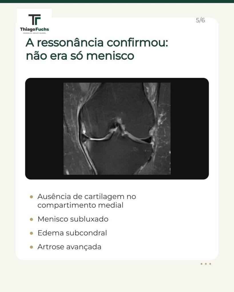 A ressonância confirmou que não era só menisco: ausência de cartilagem no compartimento medial, menisco subluxado, edema subcondral e artrose avançada.