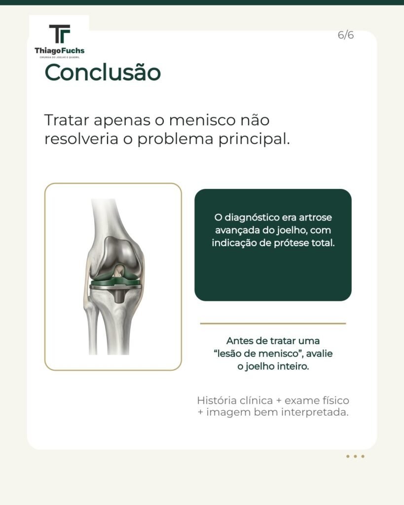 Conclusão: tratar apenas o menisco não resolveria o problema principal. O diagnóstico era artrose avançada do joelho, com indicação de prótese total.