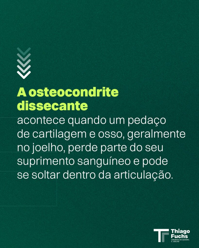 A osteocondrite dissecante acontece quando um pedaço de cartilagem e osso, geralmente no joelho, perde parte do seu suprimento sanguíneo e pode se soltar dentro da articulação.