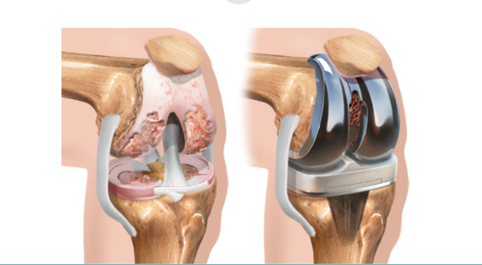 artroplastia do joelho site