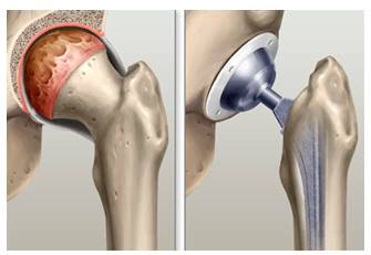 artroplastia toral do quadril