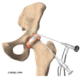 artroscopia do quadril