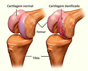 cartilagem-joelho