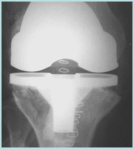 Fig 2b- rediografia pós-operatória com enxerto ósseo autólogo, obtido do côndilo femoral