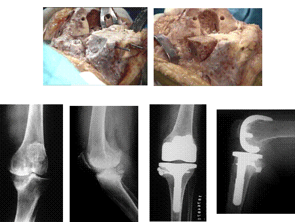 Figura 3: a- aspecto clínico da paciente, mostrando grande deformidade angular dos membros inferiores. b- aspecto intraoperatório mostrando a extensão do defeito tibial posteromedial.no joelho esquerdo e preenchimento com enxerto ósseo homólogo (cabeça femoral), fixado com 2 parafusos. c- aspecto radiográfico pré e pós-operatório com 1 ano de evolução.