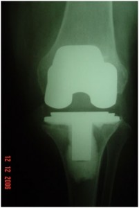 Fig.1 – Radiografia  ATJ – 10 meses PO com soltura.