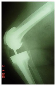 Fig.4-D – Radiografia em perfil – 7 anos PO