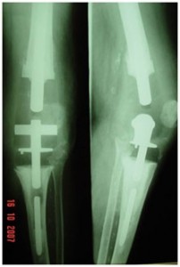 Fig.5 – Radiografia em AP e perfil – Prótese tumoral constrita