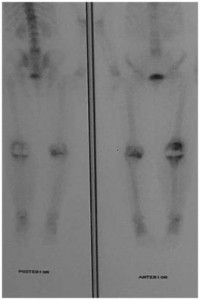 Fig.7-C – Cintilografia óssea com Tecnécio99 – 10 meses   Pós-ATJ com hipercaptação