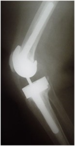 Fig.10-B – Radiografia em perfil – 9 anos PO