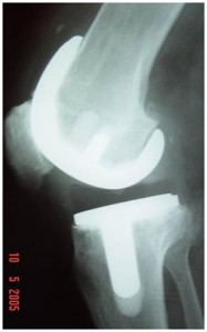 Fig.2-B – Radiografia em perfil – 4 anos PO – Desbrida-                               mento e troca do polietileno.