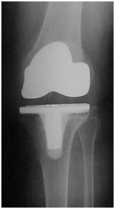Fig.4-A – Radiografia em AP – paciente de 60 anos – 10          meses de PO – soltura por infecção