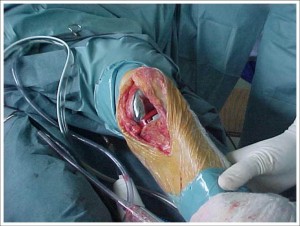 Fig. 8.7 – ATJ – Artrose FP isolada – Flexo-extensão pér-operatória sem luxação da patela – Fonte HNM
