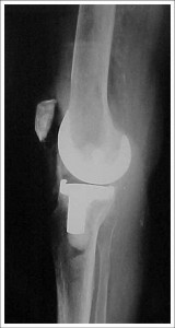 Fig. 8.9 – ATJ – Artrose FP isolada – RX pós-operatório – perfil – Fonte HNM