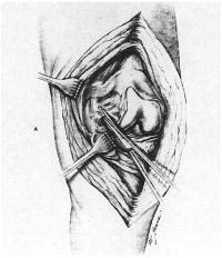 Fig. 8.10 – Liberação ligamento FP lateral, levando a melhor exposição – Fonte “Krackow KA, in patella in total knee artroplasty”
