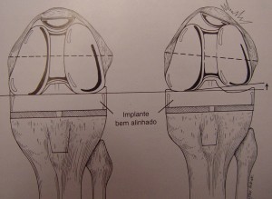 Fig. 8.11 – Rotação do componente femoral 
