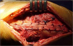 Fig. 8.20 – Desbridamento da lesão / reparo direto / reforço com ligamento sintético de poliéster – Fonte HNM