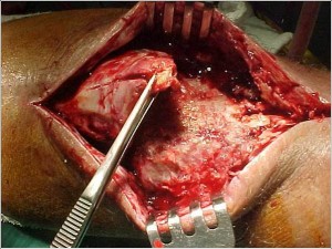 Fig. 8.21 – Lesão tendão patelar – pér-operatório - Fonte HNM