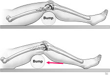 Fig.1 – Coxim (“bump”) sob o joelho ou sob o foco de fratura.            Fonte: Horwitz et al. J Bone Joint Surg Am. 2009;91:2970.