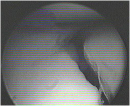 Fig.6-A/B – Controle artroscópico de redução de fratura de planalto tibial.                      Pré-redução (A). Pós-redução (B).         Fonte: Hospital Novo Mundo / Curitiba-PR.   