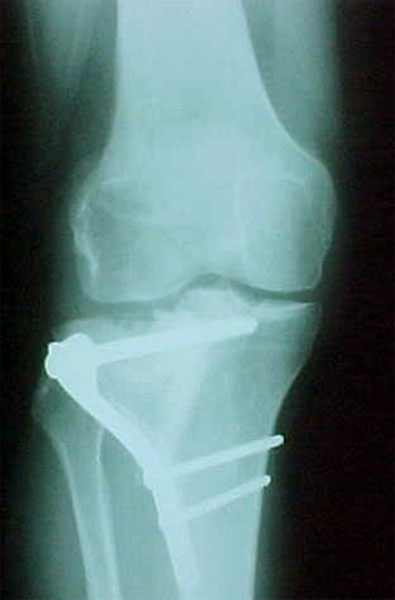 Fig.8 – Fratura planalto tibial lateral fixada com placa não bloqueada. Fonte: Hospital Novo Mundo / Curitiba-PR.