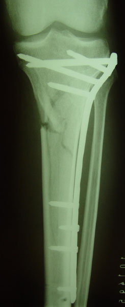 Fig.9-A/B – Fratura bicondilar do planalto tibial com grande fragmento medial fixada                       com placa bloqueda.. 	        Fonte: Hospital Novo Mundo / Curitiba-PR.