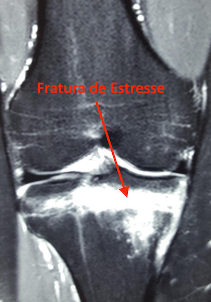 fratura por estresse no joelho