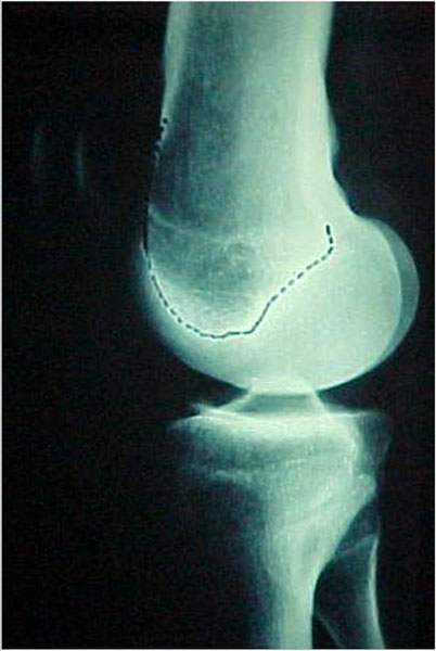 Fig.1 - Tróclea femoral normal