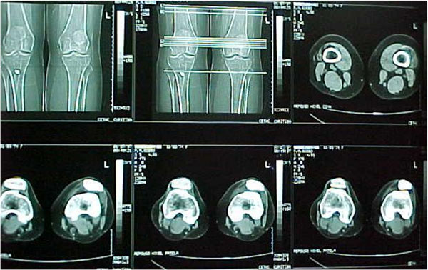 Fig.13-A - TAC. - Cortes diversos. 