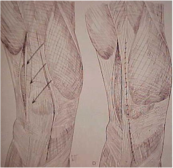 Fig.15 - Liberação da retinácula lateral / Avanço tendão do vasto medial