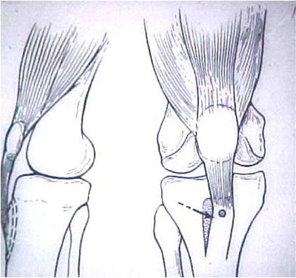 Fig.16 – Desenho - Medialização da TAT – Cirurgia de Elmslie-Trillat