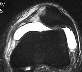 Fig.18 - Ligamento femoropatelar medial (LFPM) – Ressonância - lesão