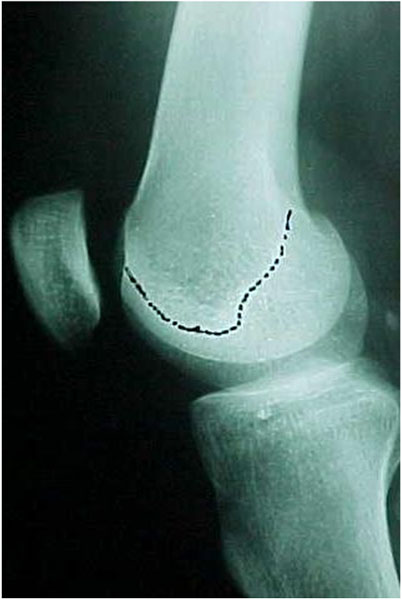 Fig.2 - Tróclea femoral displásica