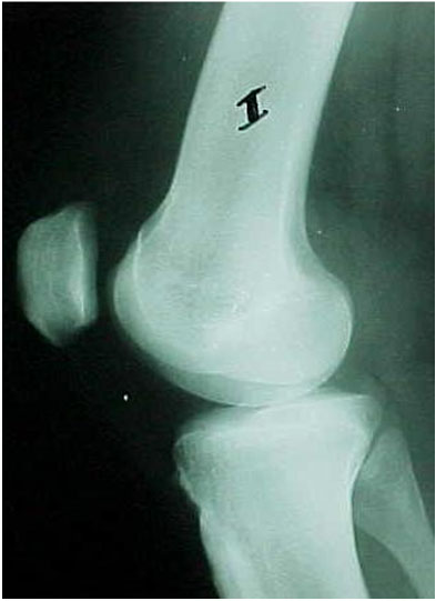 Fig-3-A – Displasia tróclea tipo I