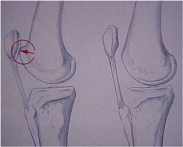 Fig.4-A – Desenho da “saliência” da tróclea