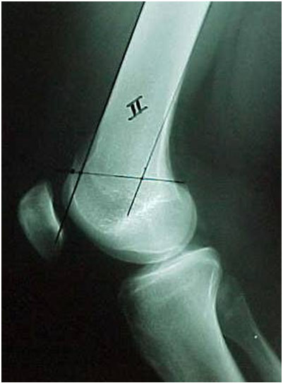 Fig-4-B – Radiografia da “saliência” da tróclea