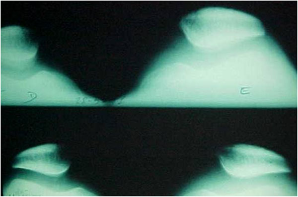 Fig.5 – Radiografia axial de patela – ângulo da tróclea