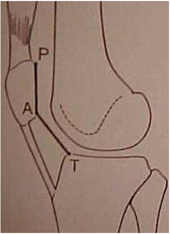  Fig-6-A – Desenho da medida do Índice Patelar (IP) – Caton-Deschamps