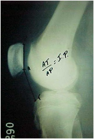 Fig.-¨-B – Radiografia em perfil absoluto – I.P segundo Caton-Deschamps