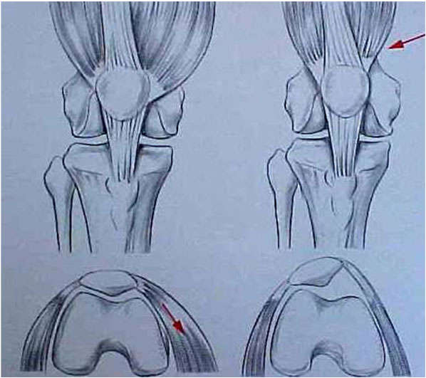 Fig.8 – Desenho da displasia músculo vasto medial