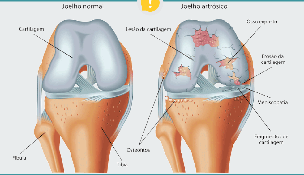 joelho degenerativo